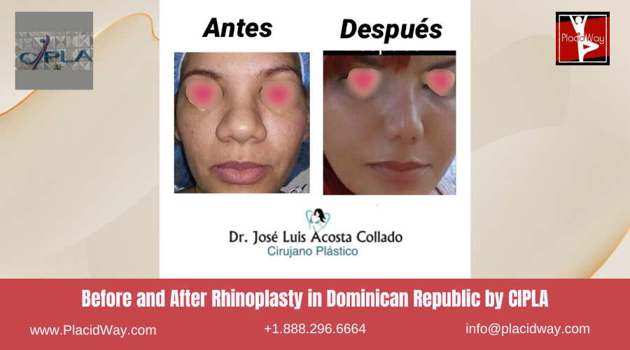 Rhinoplasty in Dominican Republic by CIPLA