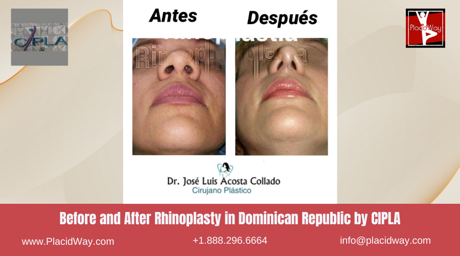 Nose Surgery in Dominican Republic by CIPLA