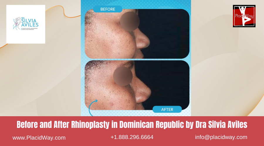 Nose Surgery in Dominican Republic by Dra Silvia Aviles