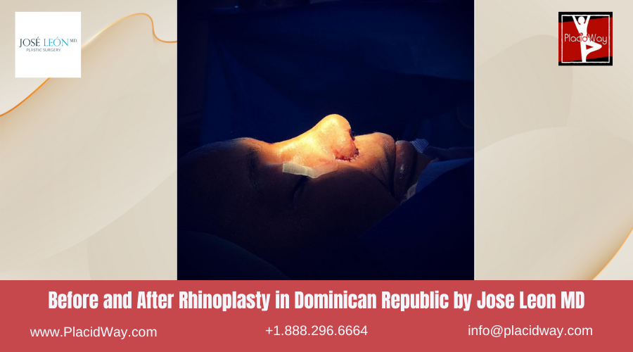 Rhinoplasty in Dominican Republic by Jose Leon MD