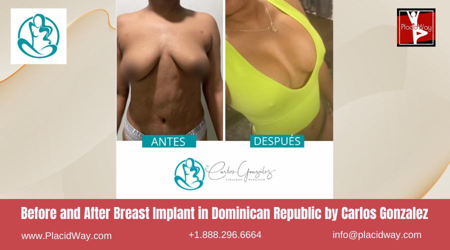Breast Augmentation in Dominican Republic by Carlos Gonzalez