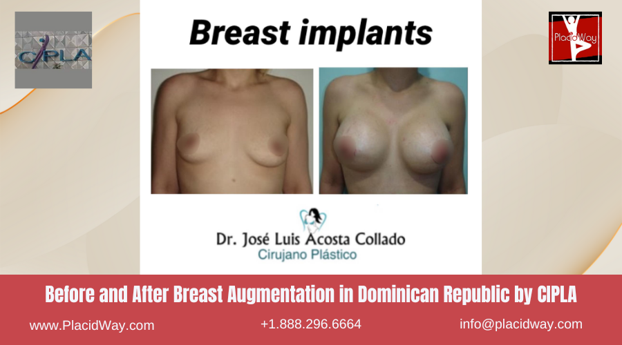 Breast Augmentation in Dominican Republic by CIPLA