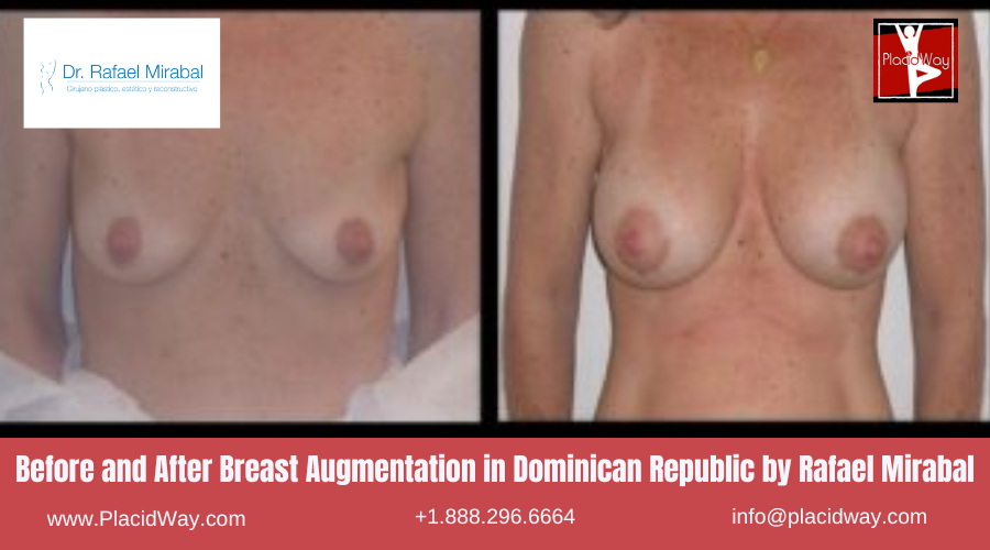 Breast Implant in Dominican Republic by Dr Rafael Mirabal