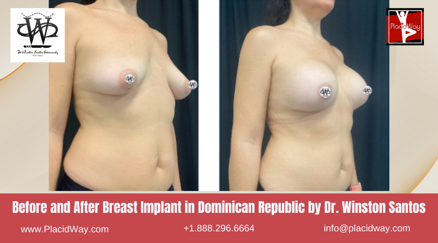 Breast Augmentation in Dominican Republic by Dr Winston Santos