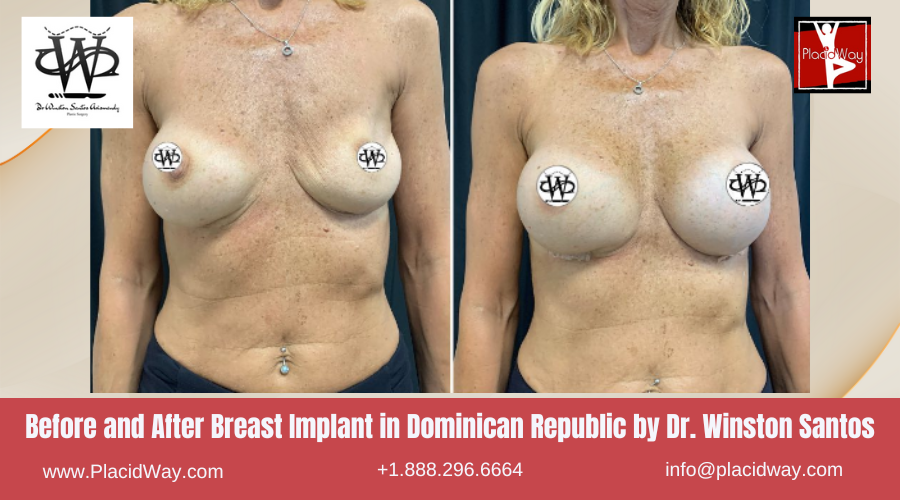Breast Implant in Dominican Republic by Dr Winston Santos