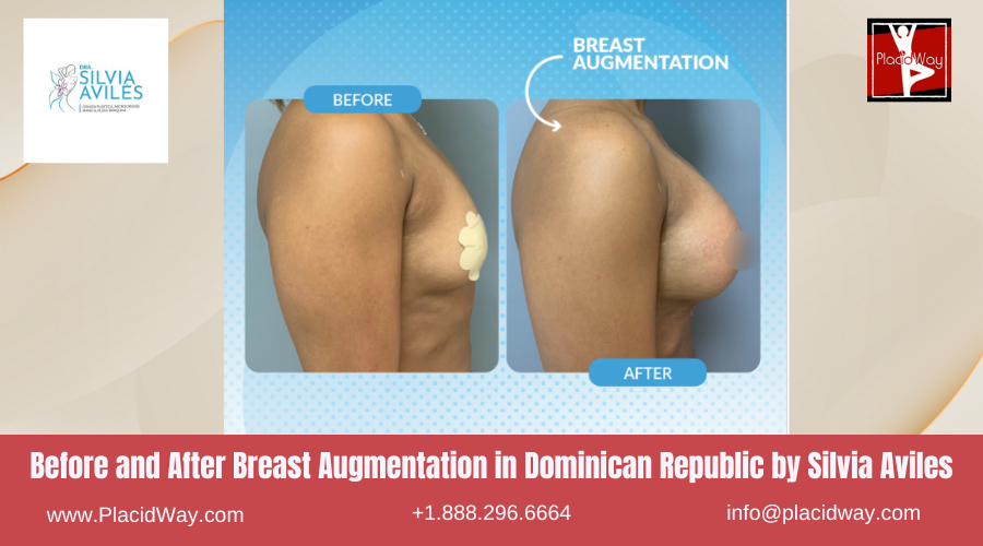Breast Augmentation in Dominican Republic by Dra Silvia Aviles
