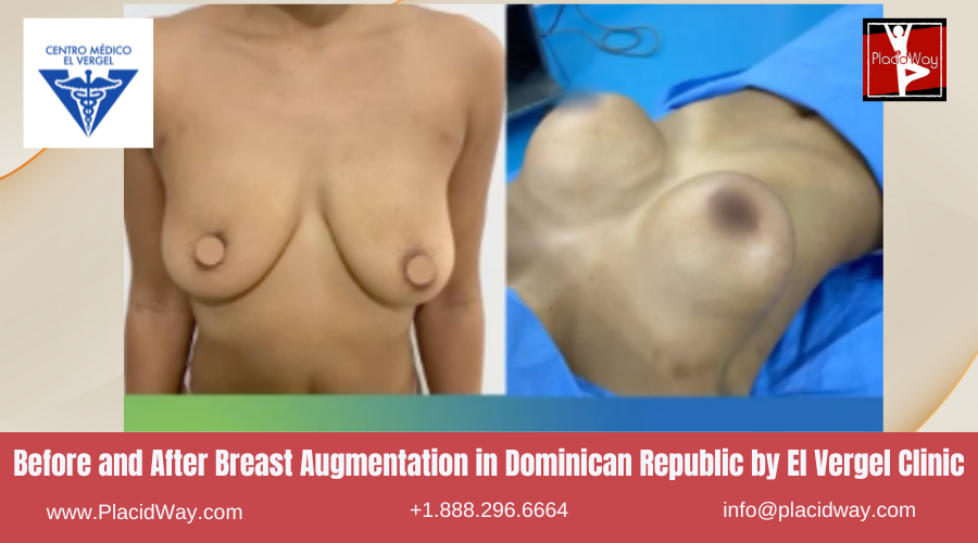 Breast Augmentation in Dominican Republic by El Vergel Clinic