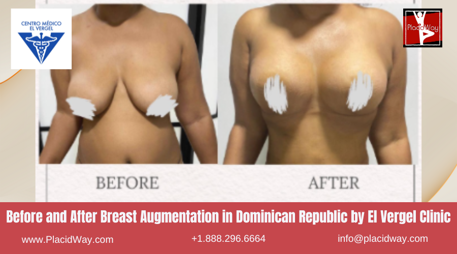 Breast Implant in Dominican Republic by El Vergel Clinic