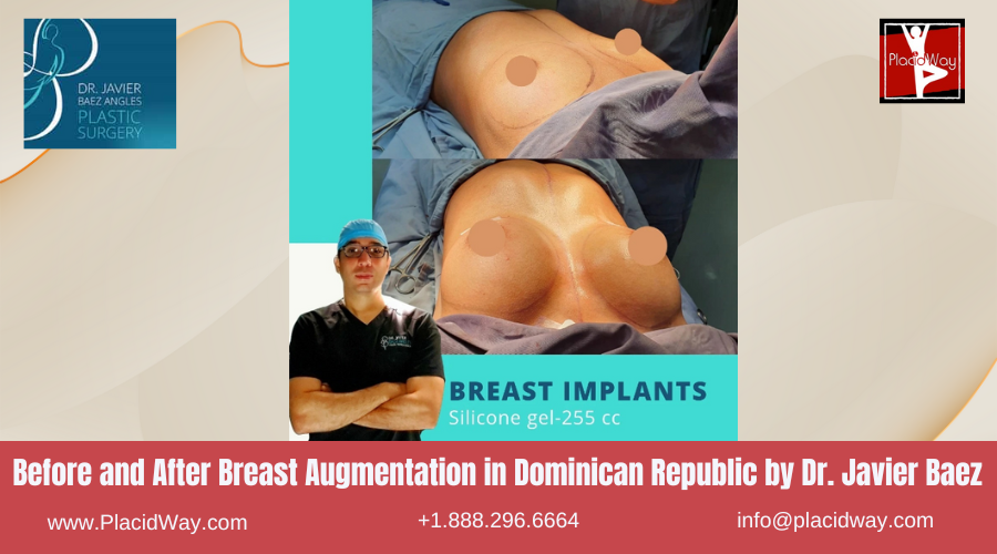 Breast Augmentation in Dominican Republic by Javier Baez