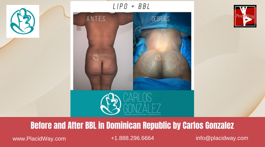 BBL in Dominican Republic by Dr. Carlos Gonzalez