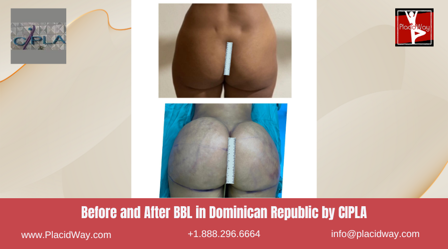 BBL in Dominican Republic by CIPLA
