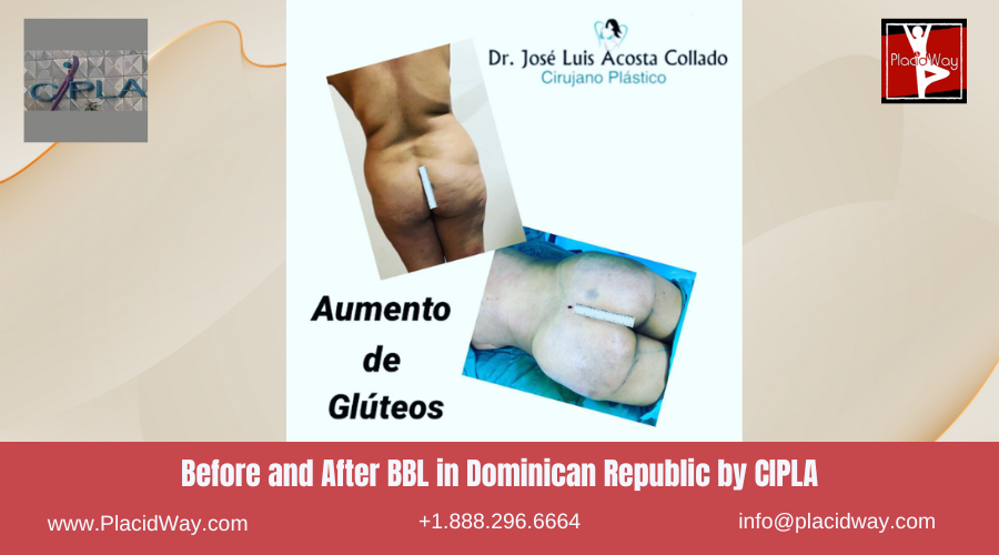 Brazilian Butt Lift in Dominican Republic by CIPLA