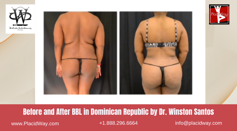 BBL in Dominican Republic by Dr Winston Santos