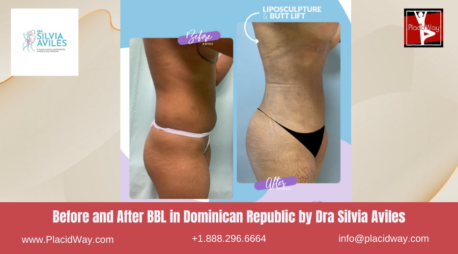 BBL in Dominican Republic by Dra Silvia Aviles