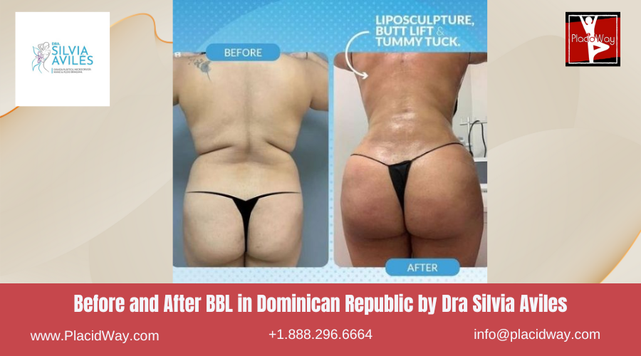 Brazilian Butt Lift in Dominican Republic by Dra Silvia Aviles