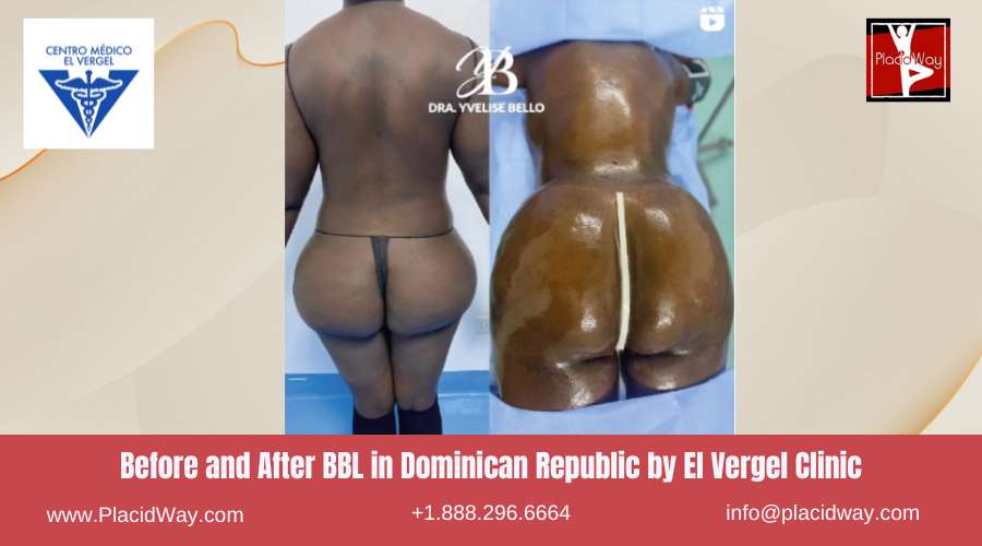 BBL in Dominican Republic by El Vergel Clinic