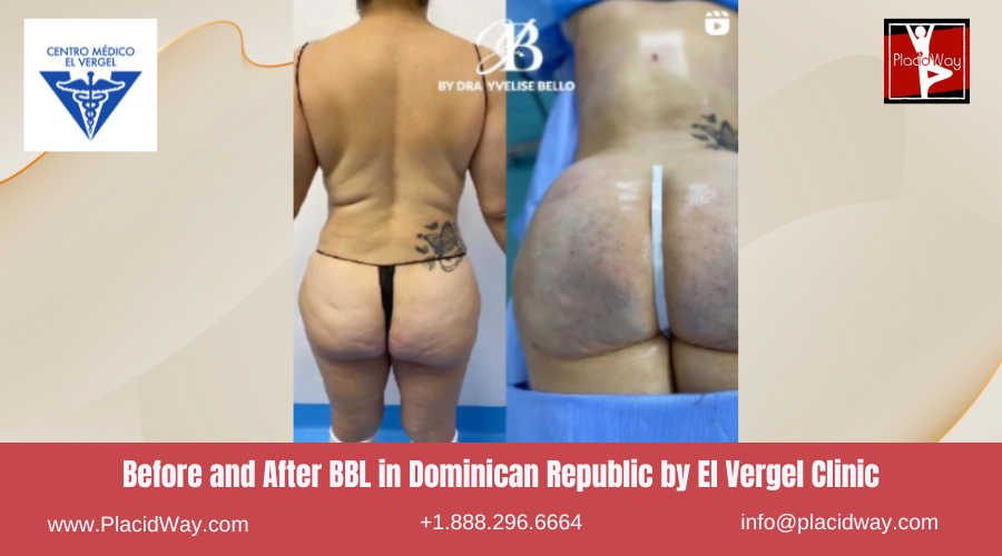 BBL in Dominican Republic by Centro Medico el Vergel