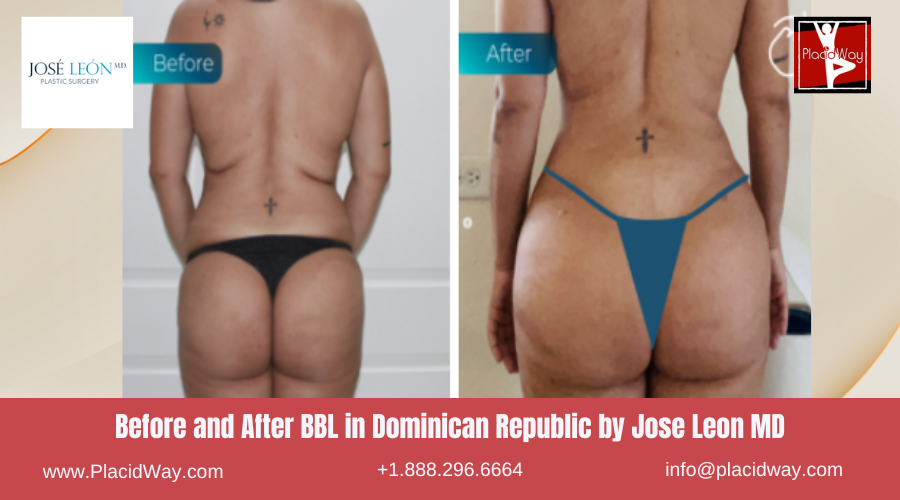 Brazilian Butt Lift in Dominican Republic by Jose Leon MD