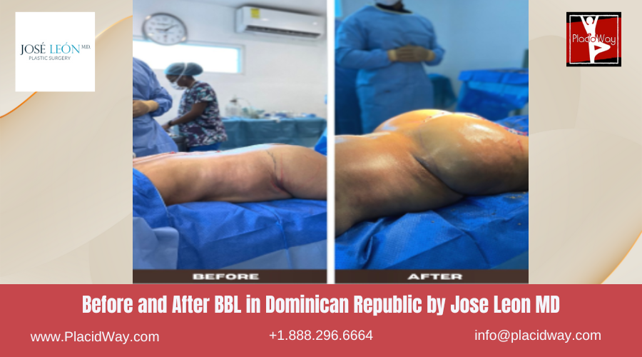 BBL in Dominican Republic by Jose Leon MD