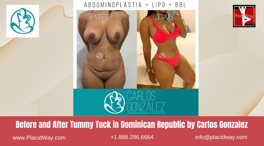 Tummy Tuck in Dominican Republic by Carlos Gonzalez