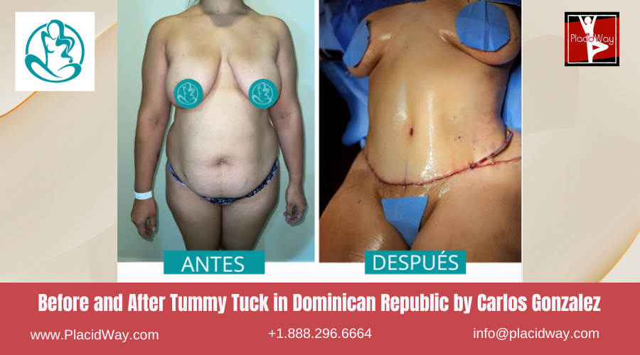 Abdominoplasty in Dominican Republic by Carlos Gonzalez