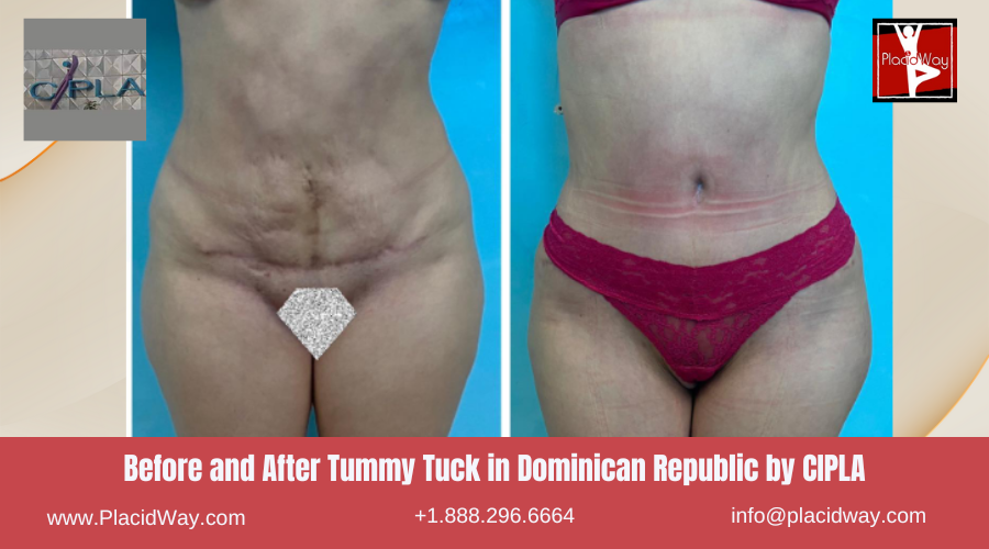 Tummy Tuck in Dominican Republic by CIPLA