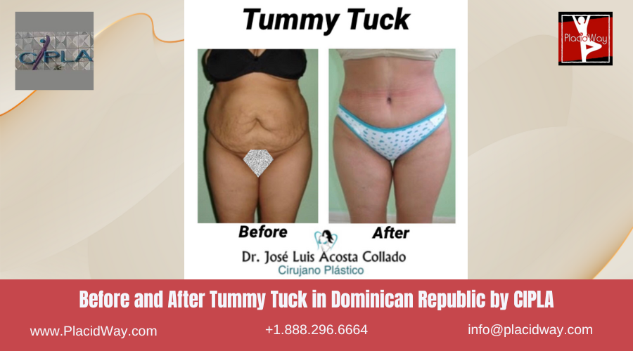 Abdominoplasty in Dominican Republic by CIPLA