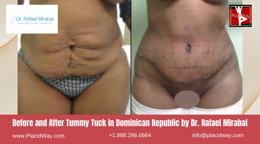 Tummy Tuck in Dominican Republic by Dr Rafael Mirabal