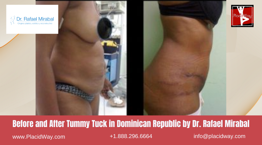 Abdominoplasty in Dominican Republic by Dr Rafael Mirabal