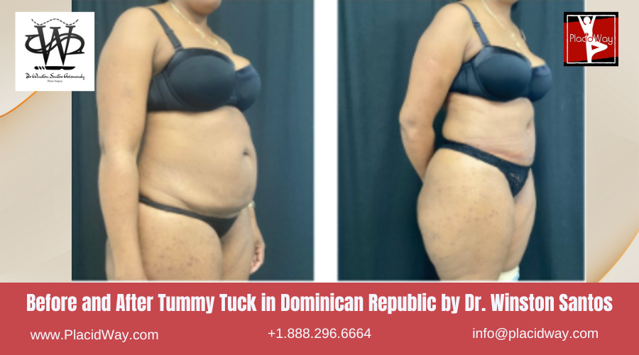 Tummy Tuck in Dominican Republic by Dr Winston Santos