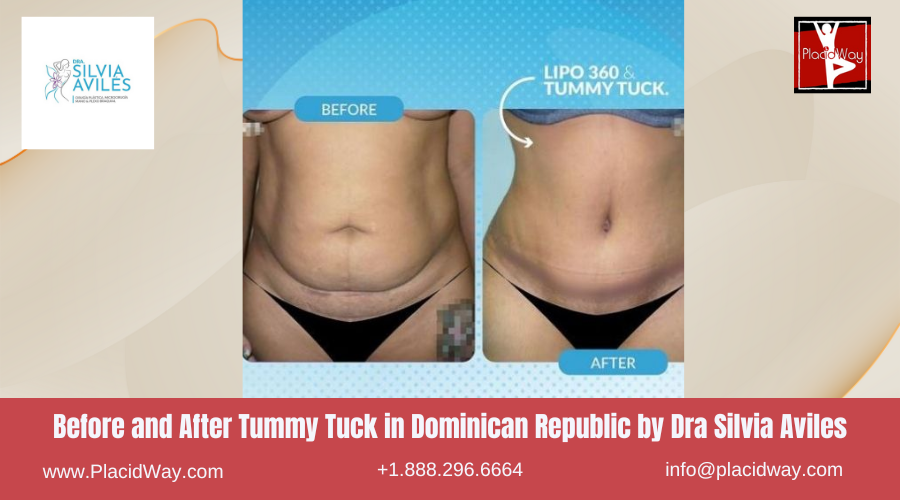 Tummy Tuck in Dominican Republic by Dra Silvia Aviles