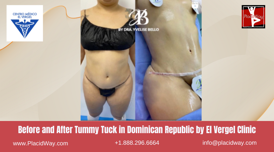 Tummy Tuck in Dominican Republic by El Vergel Clinic