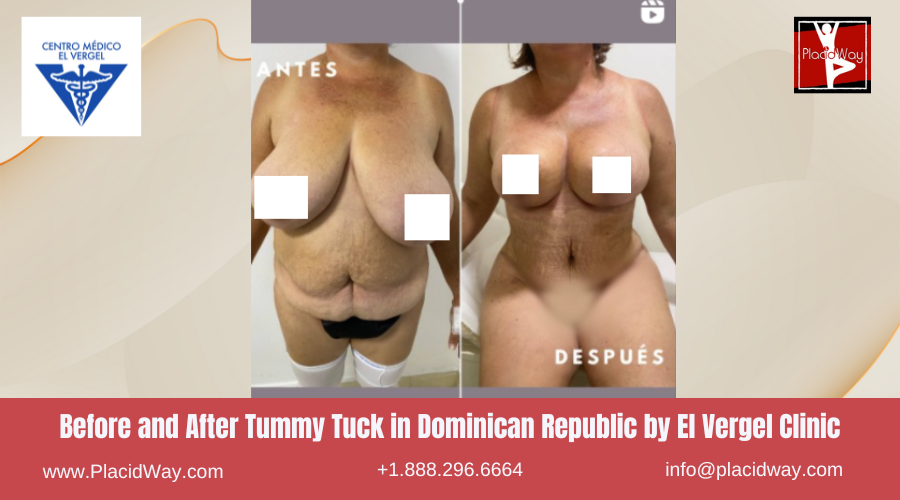 Abdominoplasty in Dominican Republic by El Vergel Clinic