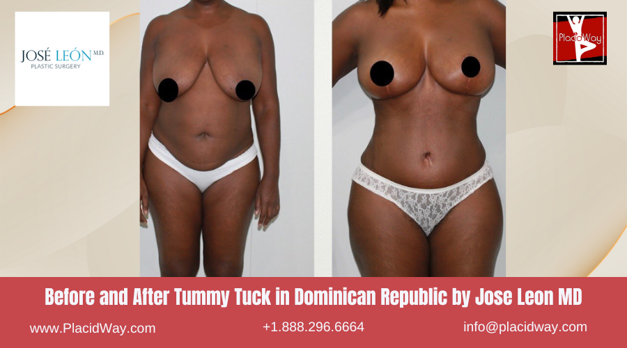 Tummy Tuck in Dominican Republic by Jose Leon MD
