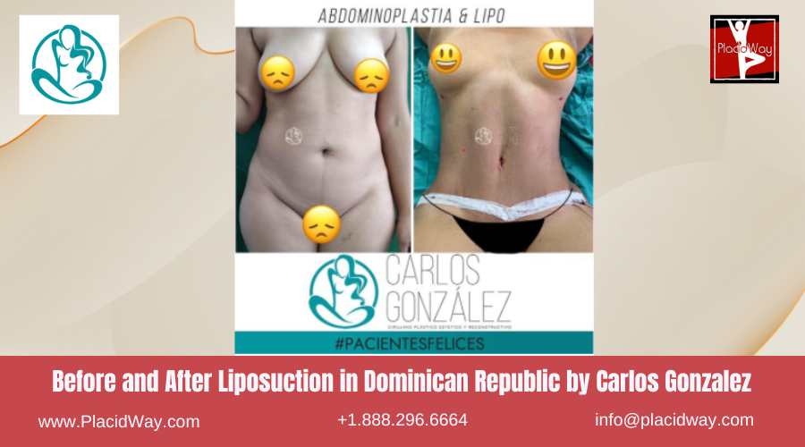 Liposuction in Dominican Republic by Carlos Gonzalez