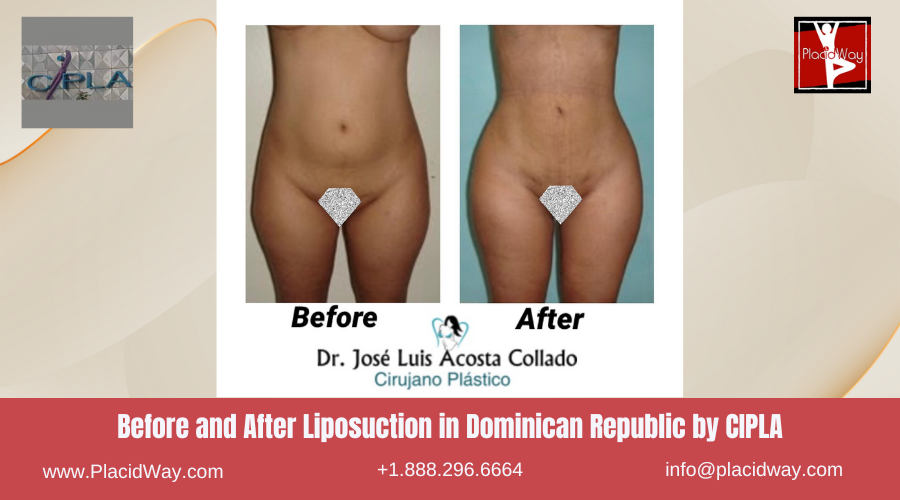Liposuction in Dominican Republic by CIPLA