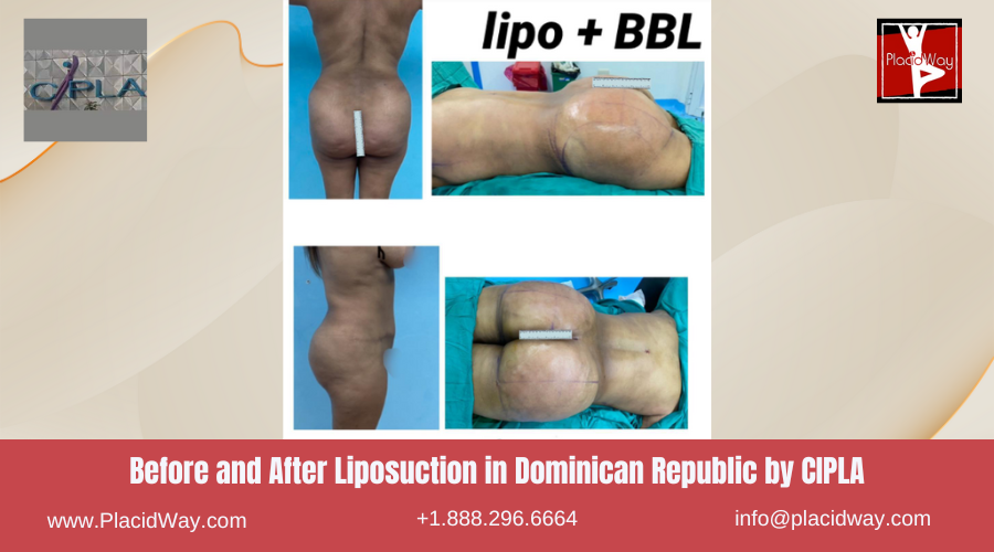 Lipo360 in Dominican Republic by CIPLA