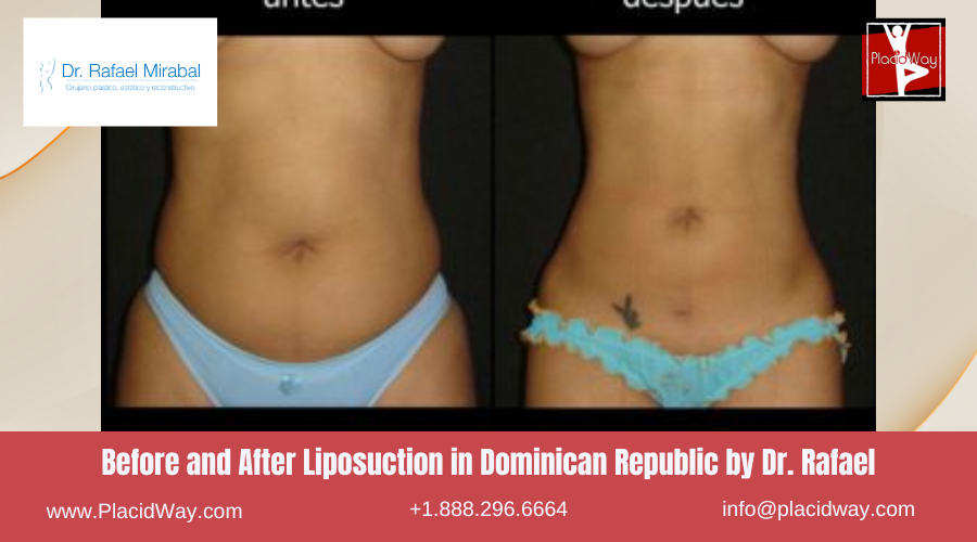 Liposuction in Dominican Republic by Dr Rafael Mirabal