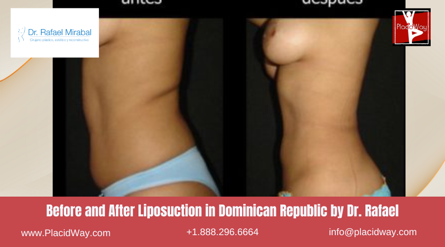 Lipo360 in Dominican Republic by Dr Rafael Mirabal