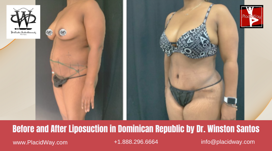 Liposuction in Dominican Republic by Dr Winston Santos