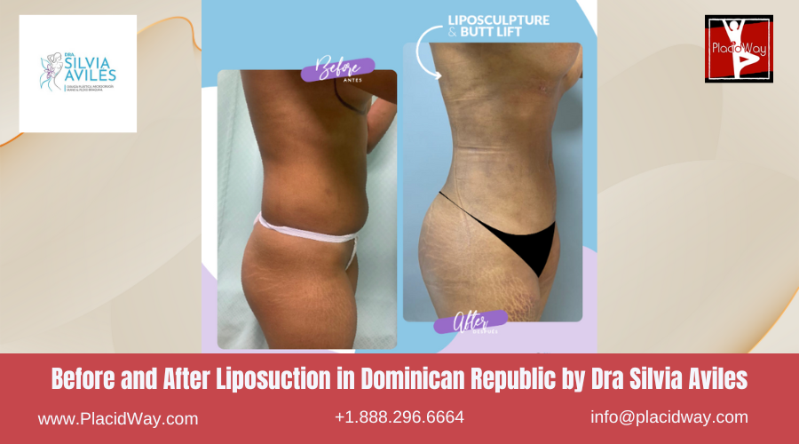 Liposuction in Dominican Republic by Dra Silvia Aviles