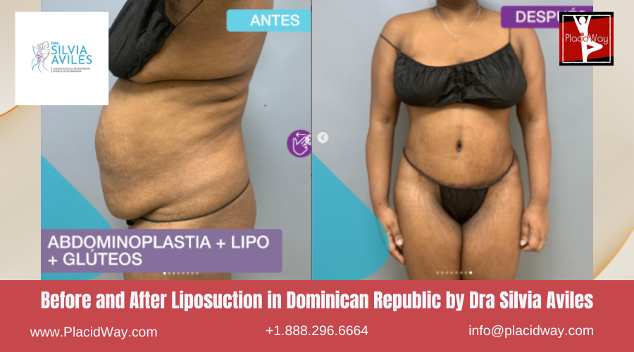 Lipo360 in Dominican Republic by Dra Silvia Aviles