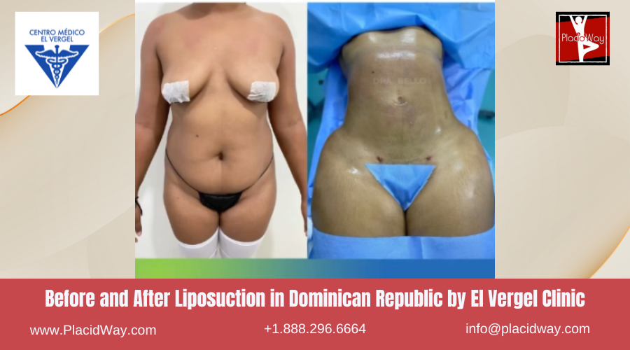 Liposuction in Dominican Republic by El Vergel Clinic