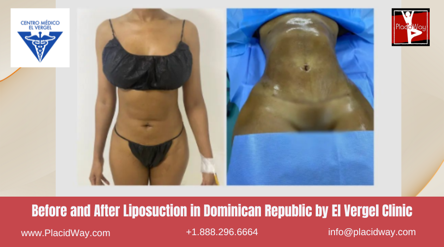 Lipo360 in Dominican Republic by El Vergel Clinic