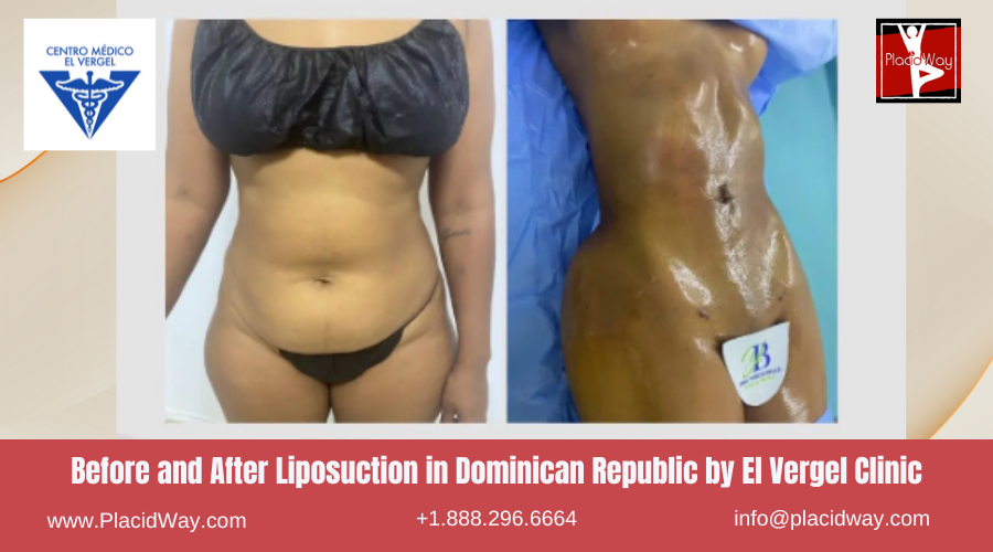 Lipo Surgery in Dominican Republic by El Vergel Clinic