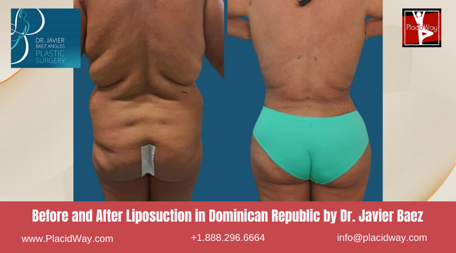 Liposuction in Dominican Republic by Javier Baez