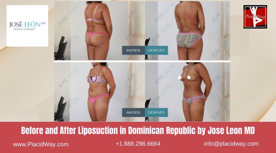 Liposuction in Dominican Republic by Jose Leon MD