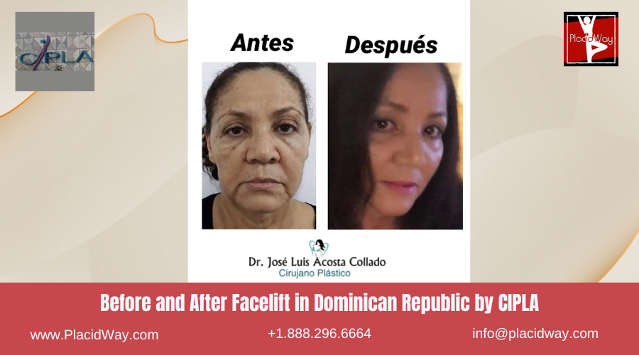 Facelift in Dominican Republic by CIPLA