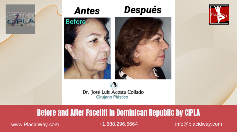 Facelift Surgery in Dominican Republic by CIPLA