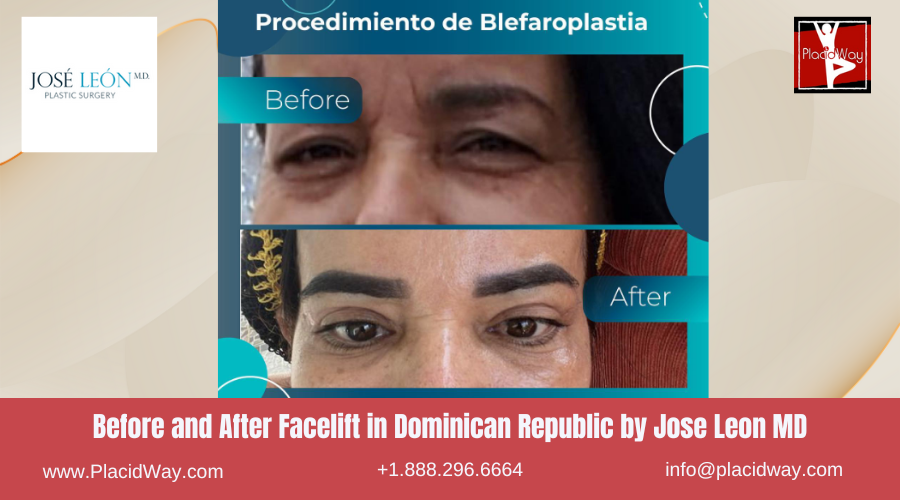Facelift in Dominican Republic by Jose Leon MD